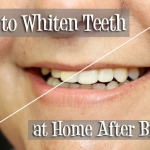 How to Whiten Teeth at Home after Braces