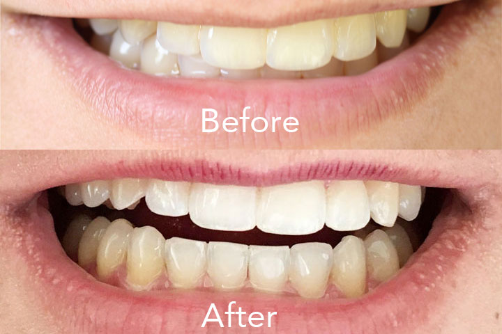 home teeth whitening results